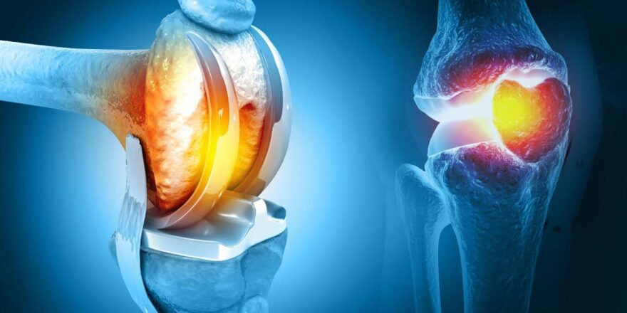 What are the Risks of delaying Knee Replacement Surgery