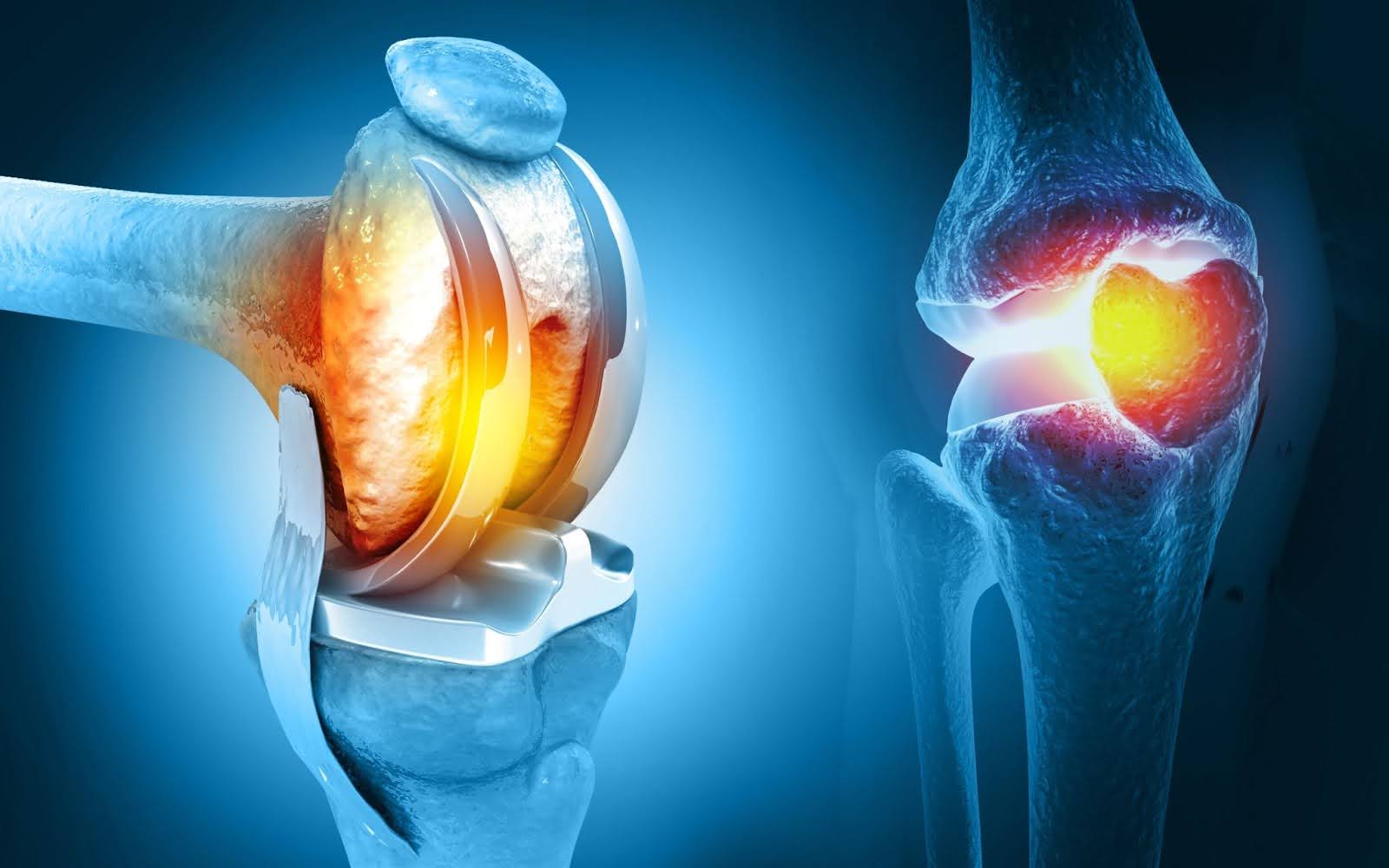 What are the Risks of delaying Knee Replacement Surgery